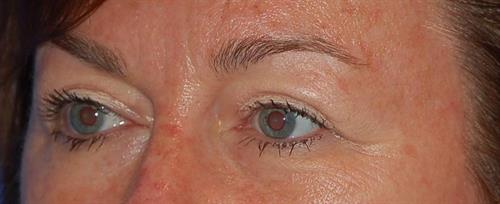 Eyelid Surgery After Photo | Phoenix and Scottsdale, AZ | Scottsdale Center for Plastic Surgery