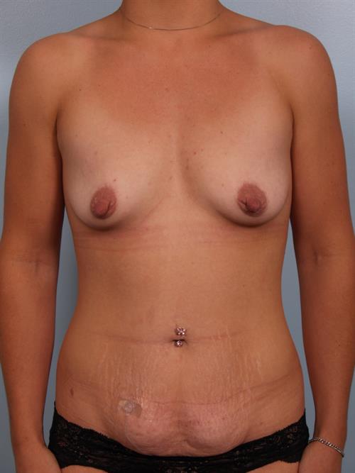 Tummy Tuck Before Photo | Phoenix and Scottsdale, AZ | Scottsdale Center for Plastic Surgery