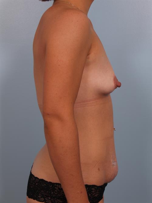 Tummy Tuck Before Photo | Phoenix and Scottsdale, AZ | Scottsdale Center for Plastic Surgery