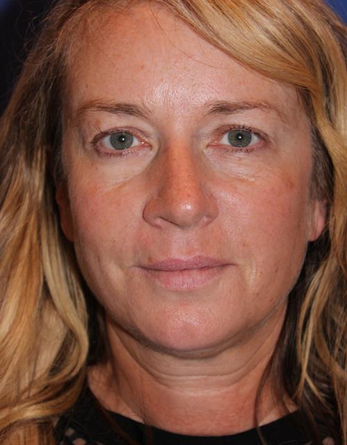 Eyelid Surgery Before Photo | Phoenix and Scottsdale, AZ | Scottsdale Center for Plastic Surgery