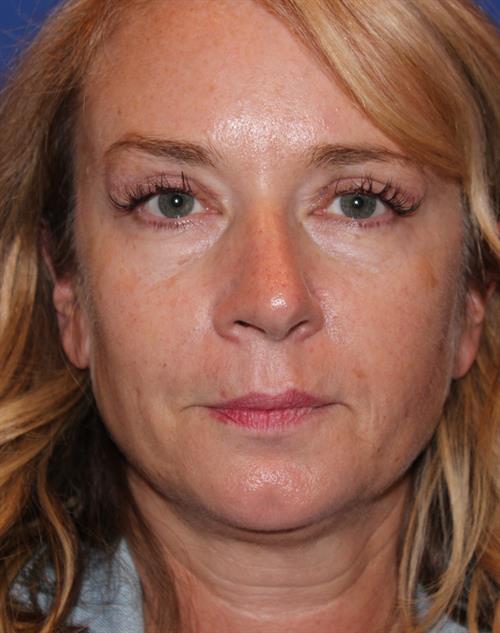 Eyelid Surgery After Photo | Phoenix and Scottsdale, AZ | Scottsdale Center for Plastic Surgery