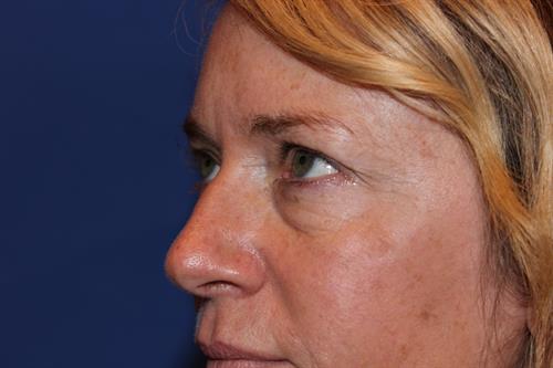 Eyelid Surgery Before Photo | Phoenix and Scottsdale, AZ | Scottsdale Center for Plastic Surgery