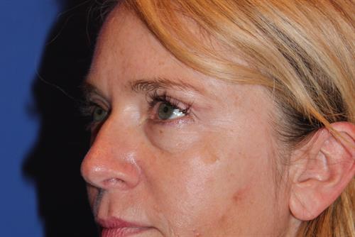 Eyelid Surgery After Photo | Phoenix and Scottsdale, AZ | Scottsdale Center for Plastic Surgery