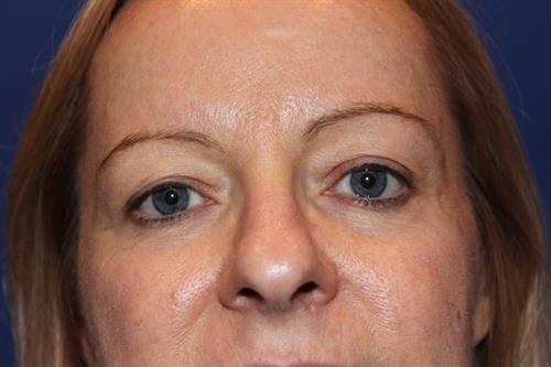 Eyelid Surgery Before Photo | Phoenix and Scottsdale, AZ | Scottsdale Center for Plastic Surgery