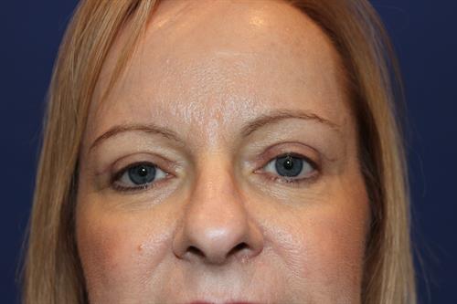 Eyelid Surgery After Photo | Phoenix and Scottsdale, AZ | Scottsdale Center for Plastic Surgery