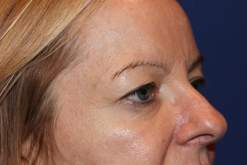 Eyelid Surgery Before Photo | Phoenix and Scottsdale, AZ | Scottsdale Center for Plastic Surgery