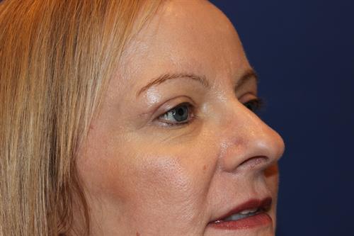 Eyelid Surgery After Photo | Phoenix and Scottsdale, AZ | Scottsdale Center for Plastic Surgery