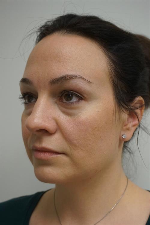 Eyelid Surgery Before Photo | Phoenix and Scottsdale, AZ | Scottsdale Center for Plastic Surgery