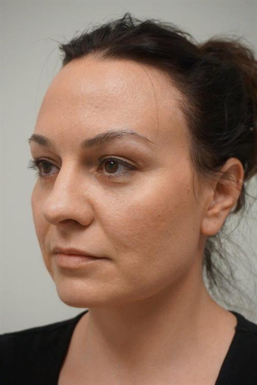 Eyelid Surgery After Photo | Phoenix and Scottsdale, AZ | Scottsdale Center for Plastic Surgery