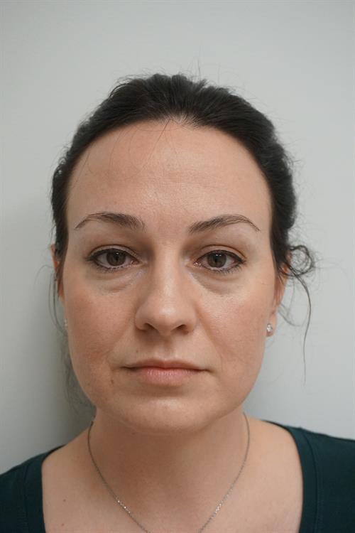 Eyelid Surgery Before Photo | Phoenix and Scottsdale, AZ | Scottsdale Center for Plastic Surgery