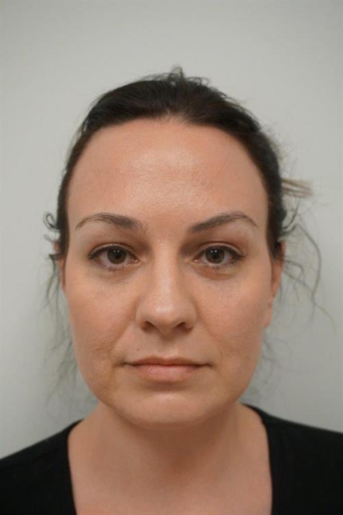 Eyelid Surgery After Photo | Phoenix and Scottsdale, AZ | Scottsdale Center for Plastic Surgery