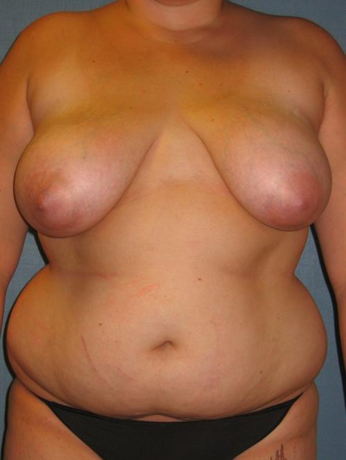 Power Assisted Liposuction Before Photo | Phoenix and Scottsdale, AZ | Scottsdale Center for Plastic Surgery