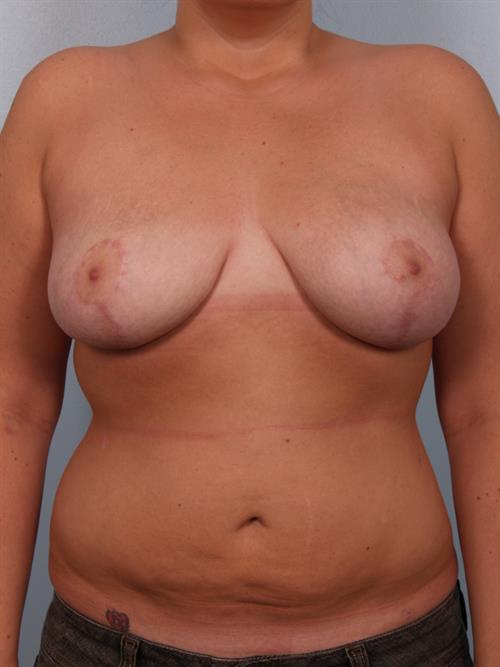 Power Assisted Liposuction After Photo | Phoenix and Scottsdale, AZ | Scottsdale Center for Plastic Surgery