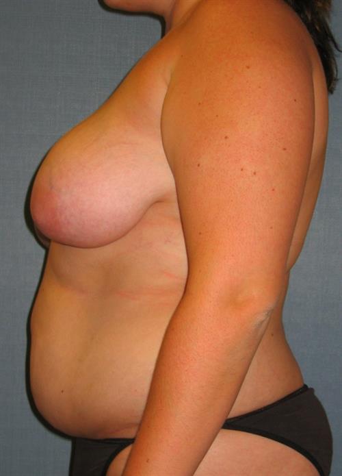Power Assisted Liposuction Before Photo | Phoenix and Scottsdale, AZ | Scottsdale Center for Plastic Surgery