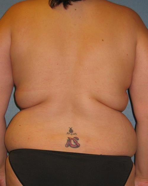 Power Assisted Liposuction Before Photo | Phoenix and Scottsdale, AZ | Scottsdale Center for Plastic Surgery