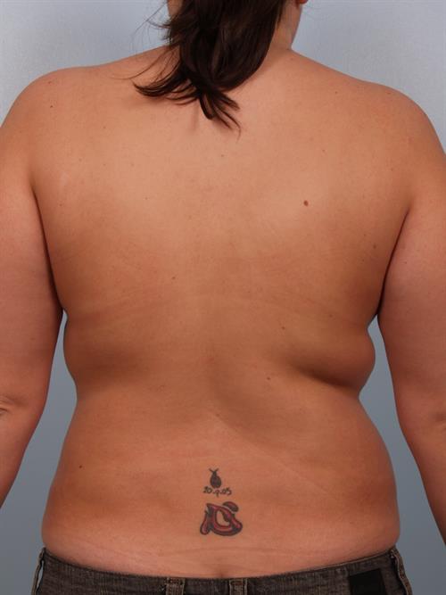 Power Assisted Liposuction After Photo | Phoenix and Scottsdale, AZ | Scottsdale Center for Plastic Surgery
