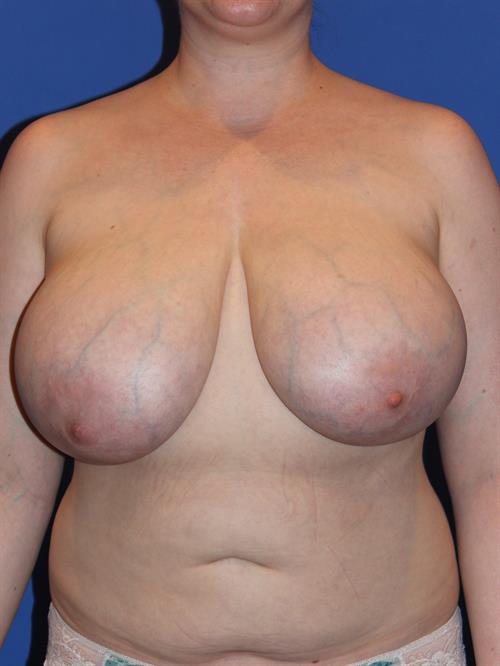 Breast Reduction Before Photo | Phoenix and Scottsdale, AZ | Scottsdale Center for Plastic Surgery