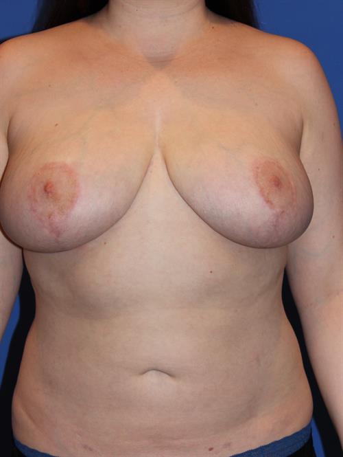 Breast Reduction After Photo | Phoenix and Scottsdale, AZ | Scottsdale Center for Plastic Surgery