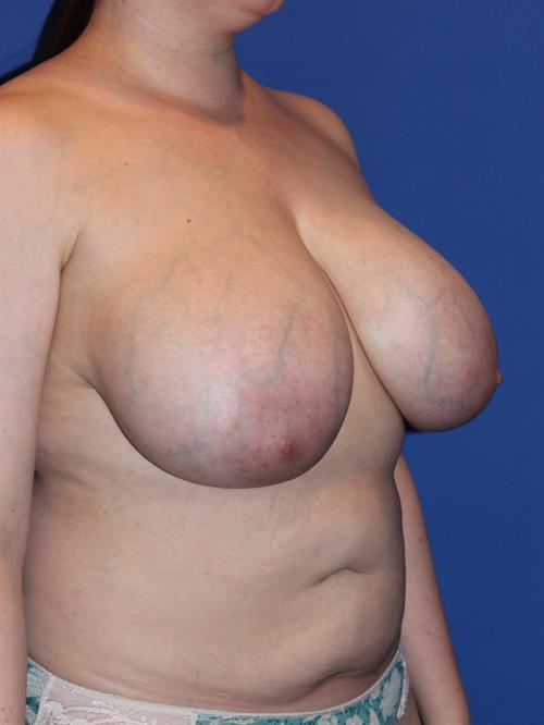 Breast Reduction Before Photo | Phoenix and Scottsdale, AZ | Scottsdale Center for Plastic Surgery