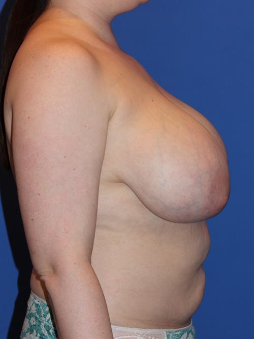 Breast Reduction Before Photo | Phoenix and Scottsdale, AZ | Scottsdale Center for Plastic Surgery