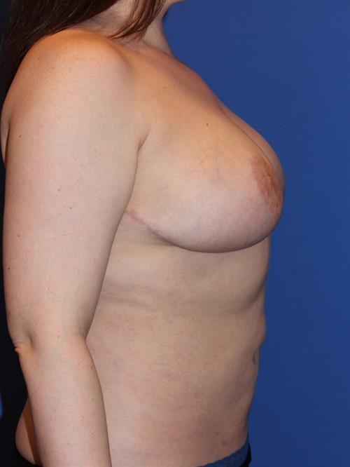 Breast Reduction After Photo | Phoenix and Scottsdale, AZ | Scottsdale Center for Plastic Surgery
