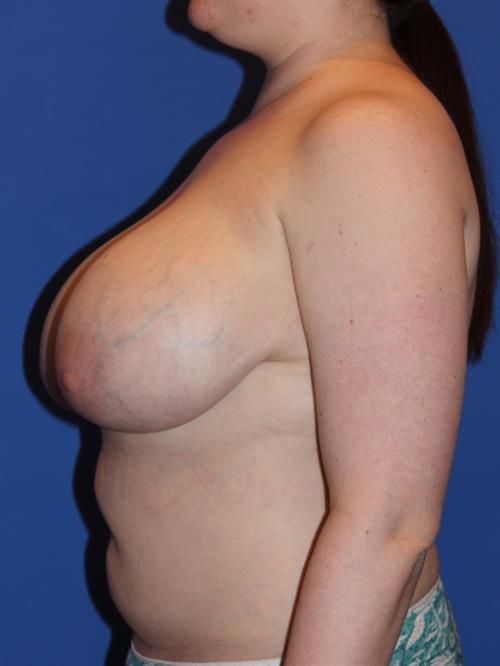 Breast Reduction Before Photo | Phoenix and Scottsdale, AZ | Scottsdale Center for Plastic Surgery