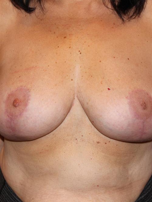Breast Reduction After Photo | Phoenix and Scottsdale, AZ | Scottsdale Center for Plastic Surgery