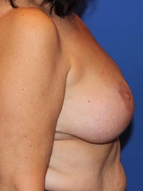 Breast Reduction After Photo | Phoenix and Scottsdale, AZ | Scottsdale Center for Plastic Surgery