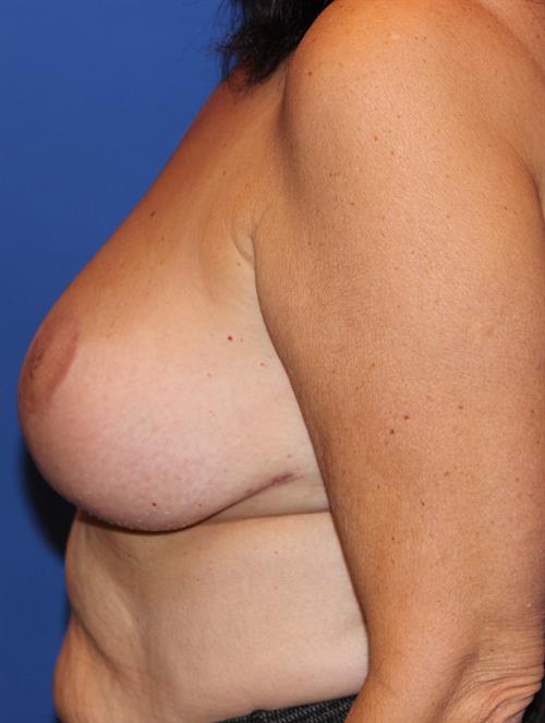 Breast Reduction After Photo | Phoenix and Scottsdale, AZ | Scottsdale Center for Plastic Surgery