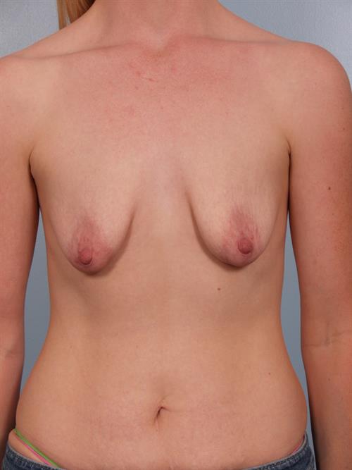Breast Lift (Mastopexy) with Implants Before Photo | Phoenix and Scottsdale, AZ | Scottsdale Center for Plastic Surgery
