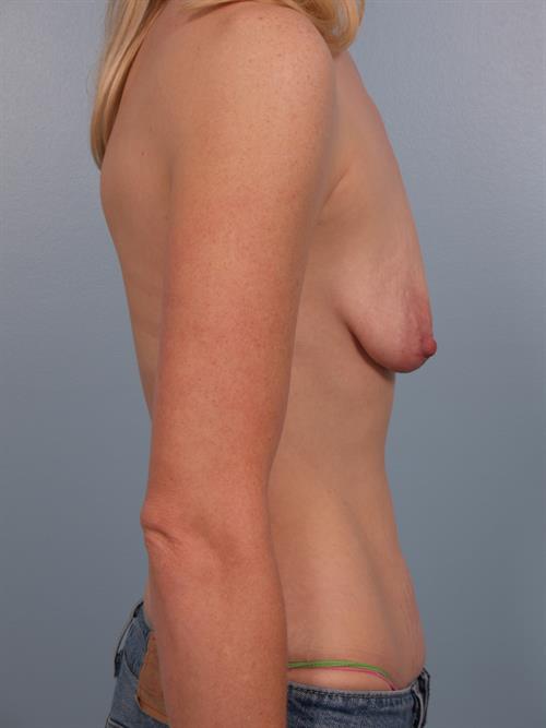 Breast Lift (Mastopexy) with Implants Before Photo | Phoenix and Scottsdale, AZ | Scottsdale Center for Plastic Surgery