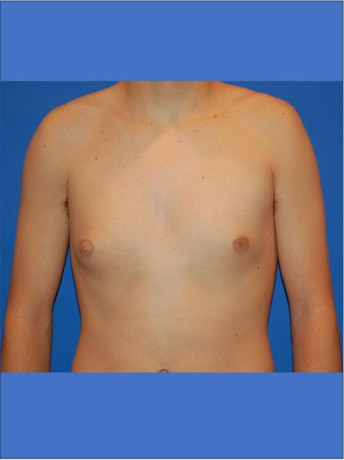 Male Breast/Areola Reduction Before Photo | Phoenix and Scottsdale, AZ | Scottsdale Center for Plastic Surgery