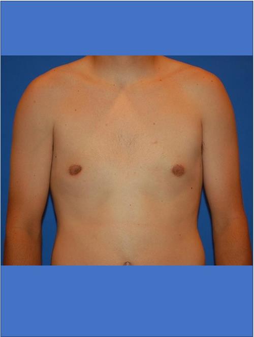 Male Breast/Areola Reduction After Photo | Phoenix and Scottsdale, AZ | Scottsdale Center for Plastic Surgery
