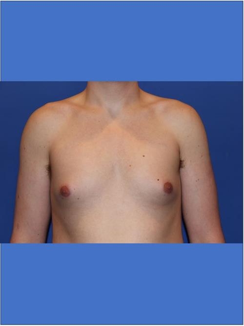 Male Breast/Areola Reduction Before Photo | Phoenix and Scottsdale, AZ | Scottsdale Center for Plastic Surgery