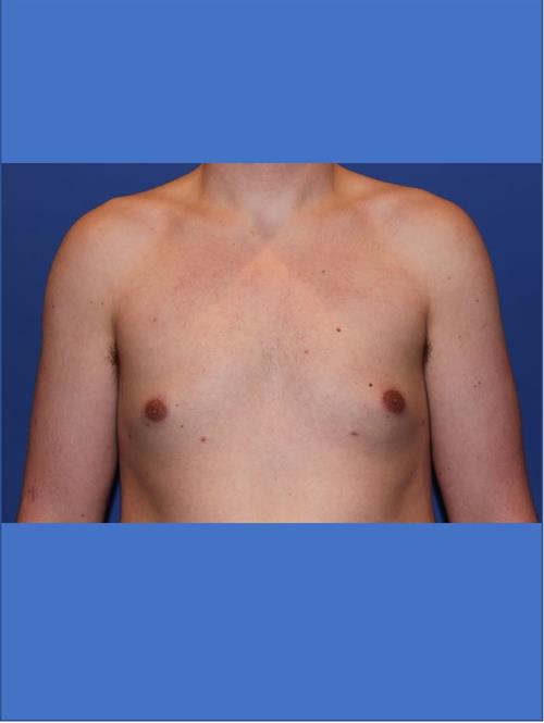Male Breast/Areola Reduction After Photo | Phoenix and Scottsdale, AZ | Scottsdale Center for Plastic Surgery
