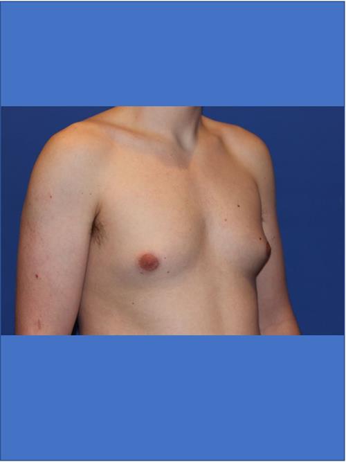 Male Breast/Areola Reduction Before Photo | Phoenix and Scottsdale, AZ | Scottsdale Center for Plastic Surgery