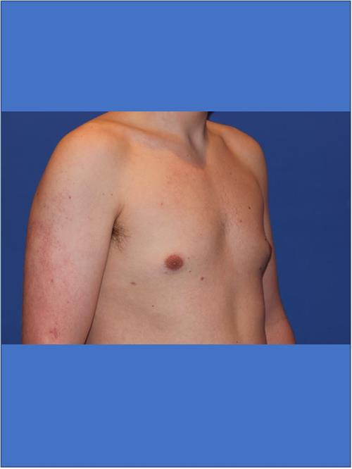 Male Breast/Areola Reduction After Photo | Phoenix and Scottsdale, AZ | Scottsdale Center for Plastic Surgery