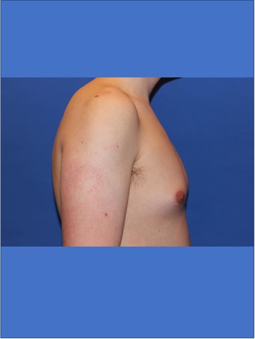 Male Breast/Areola Reduction Before Photo | Phoenix and Scottsdale, AZ | Scottsdale Center for Plastic Surgery