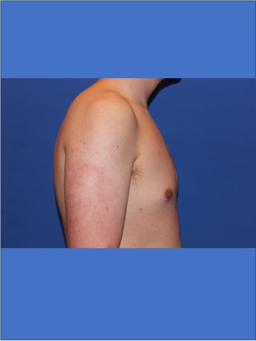 Male Breast/Areola Reduction After Photo | Phoenix and Scottsdale, AZ | Scottsdale Center for Plastic Surgery