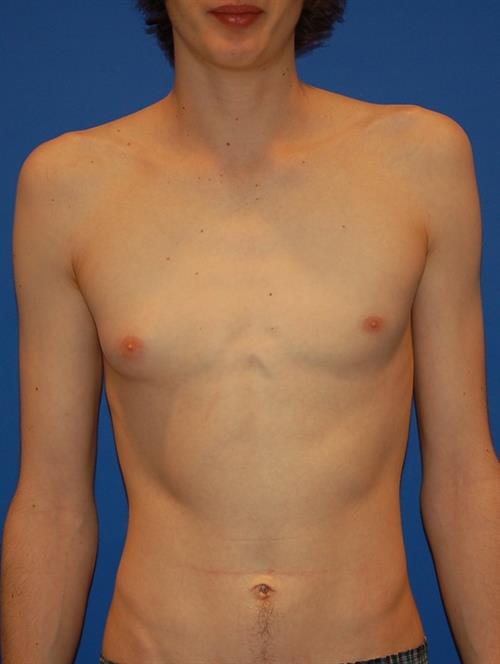 Male Breast/Areola Reduction Before Photo | Phoenix and Scottsdale, AZ | Scottsdale Center for Plastic Surgery