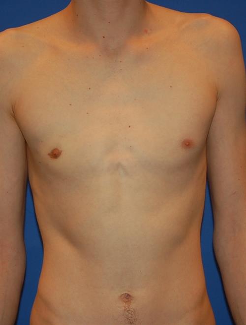 Male Breast/Areola Reduction After Photo | Phoenix and Scottsdale, AZ | Scottsdale Center for Plastic Surgery