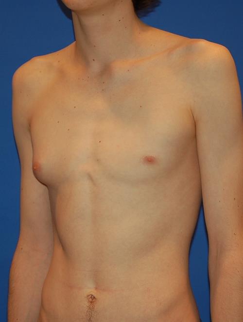 Male Breast/Areola Reduction Before Photo | Phoenix and Scottsdale, AZ | Scottsdale Center for Plastic Surgery