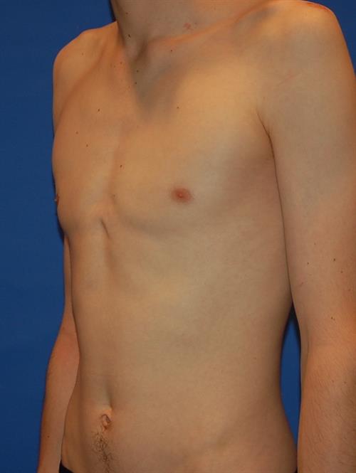Male Breast/Areola Reduction After Photo | Phoenix and Scottsdale, AZ | Scottsdale Center for Plastic Surgery