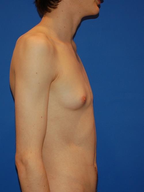 Male Breast/Areola Reduction Before Photo | Phoenix and Scottsdale, AZ | Scottsdale Center for Plastic Surgery