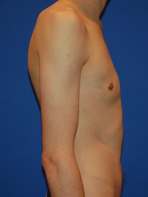 Male Breast/Areola Reduction After Photo | Phoenix and Scottsdale, AZ | Scottsdale Center for Plastic Surgery