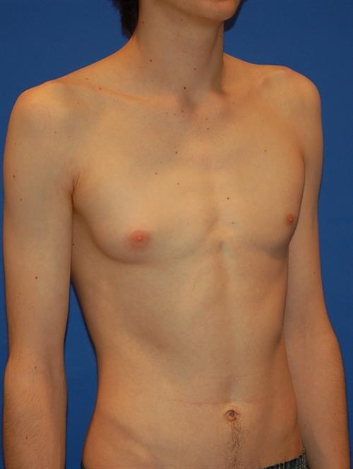 Male Breast/Areola Reduction Before Photo | Phoenix and Scottsdale, AZ | Scottsdale Center for Plastic Surgery