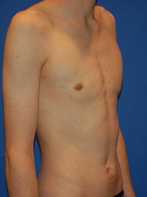 Male Breast/Areola Reduction After Photo | Phoenix and Scottsdale, AZ | Scottsdale Center for Plastic Surgery
