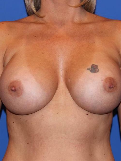 Revision Breast Surgery After Photo | Phoenix and Scottsdale, AZ | Scottsdale Center for Plastic Surgery