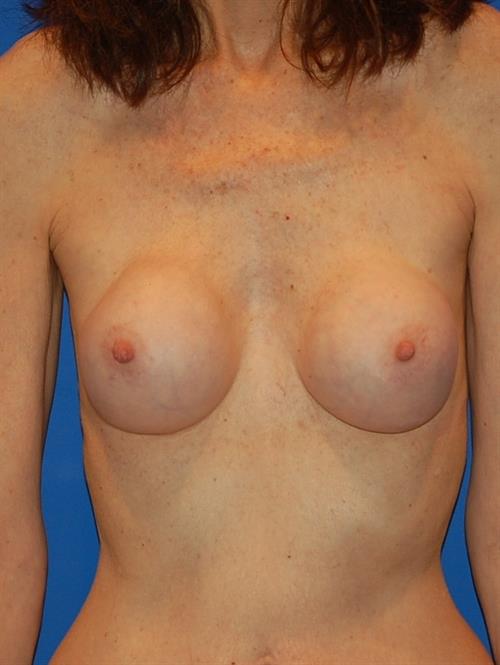Revision Breast Surgery Before Photo | Phoenix and Scottsdale, AZ | Scottsdale Center for Plastic Surgery