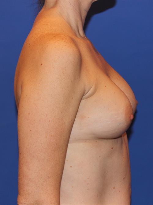 Revision Breast Surgery Before Photo | Phoenix and Scottsdale, AZ | Scottsdale Center for Plastic Surgery